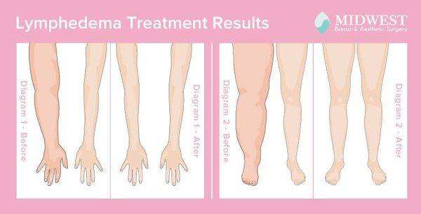 Lymphedema is swelling caused by a build-up of lymph fluid under your skin. It affects your arms or legs.