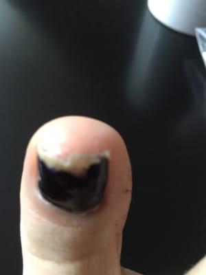 Toe nail after one week chipped and also destroyed under the polish -After one more week I lost nail from the root!