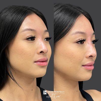 Non Surgical Nose Job before and immediately after.