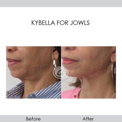 Kybella for jowls