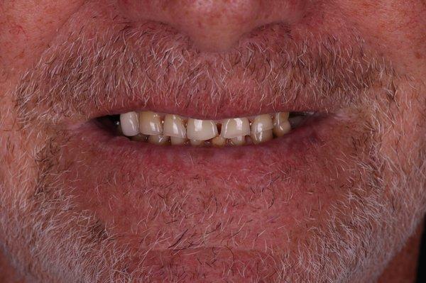 Our patient came to us with a worn down smile due to many years of wear.