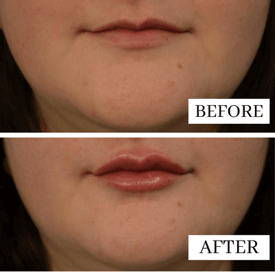 Amber used one syringe of Restylane Defyne, giving this patient a natural pout.