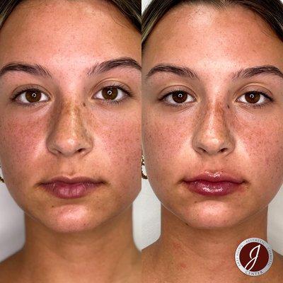 Juvederm Lip Fillers