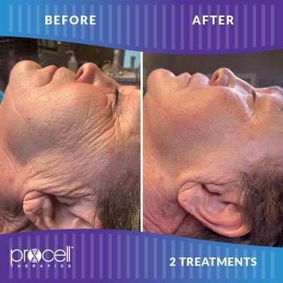 ProCell Microchanneling helps w fine lines & wrinkles. Helps tighten the skin.