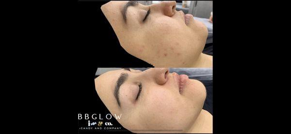 BBGLOW Facial