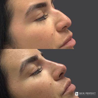 Non-Surgical Nose with Restylane Fillers.