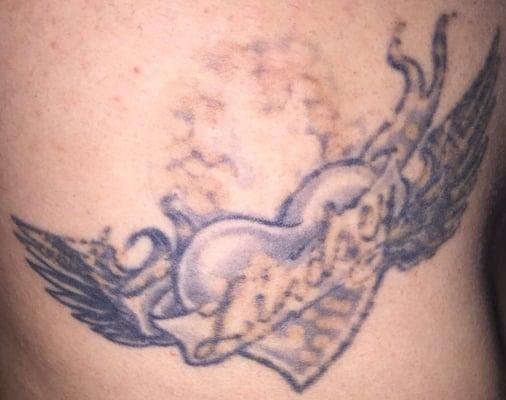 1st Tattoo Removal session