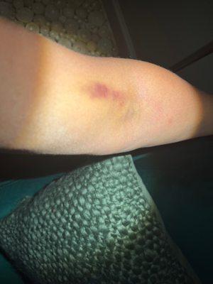 The bruises on my arm 5 days after my blood was drawn.