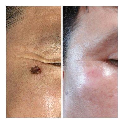 Mole Removal from Laser Treatment