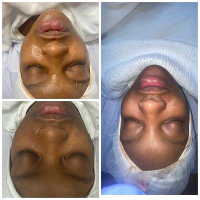 Hydrofacial 1hr treatment before , during (using our Pumpkin mask) & After, glowing bright hydrated skin.