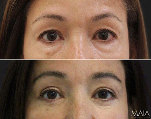 Patient's before-and-after blepharoplasty with Dr. Maia, renowned Northern Virginia plastic surgeon, showcases natural-looking results.