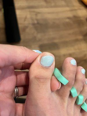 Botched pedicure