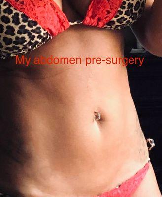 Abdomen pre-surgery