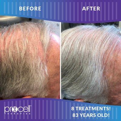 Procell Helps w Hair Growth.