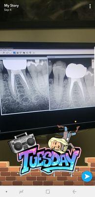 Right side was what mission hills did to fix my tooth.Left side was 3 dentists version of a proper root canal.Thank you for saving my tooth!