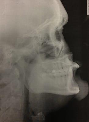 X-Ray before. Look at those things!