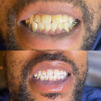 Before and after , 30 min teeth whitening session