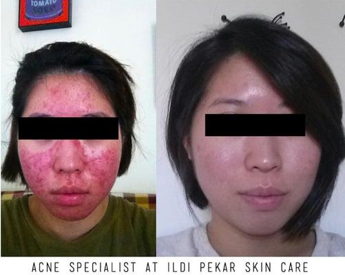 Before and After with our Acne Specialist at Ildi Pekar Skin Care. (This was a series of 12 treatments)