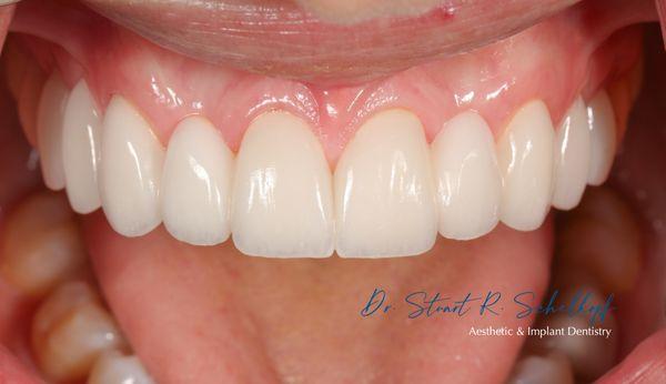 Patient flew in from Texas for her care, Veneer bridges to replace missing lateral incisors and improve this patient's smile!