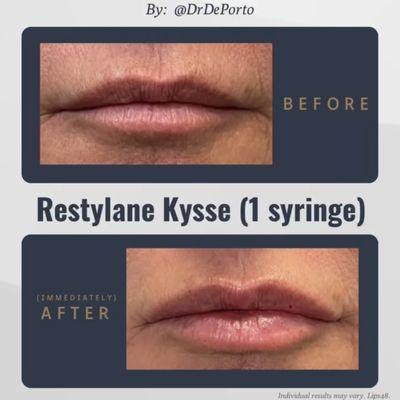 Lip Augmentation by Dr. DePorto using Restylane Kysse 1 syringe Lip Filler lip injections