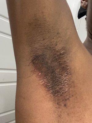 Results from underarm wax