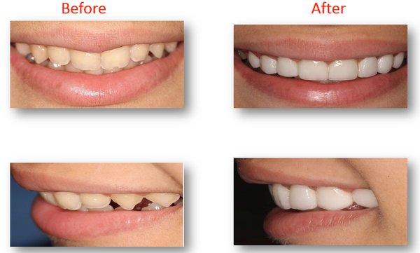 Smile Makeover case done by Dr. Lina Hamdan.