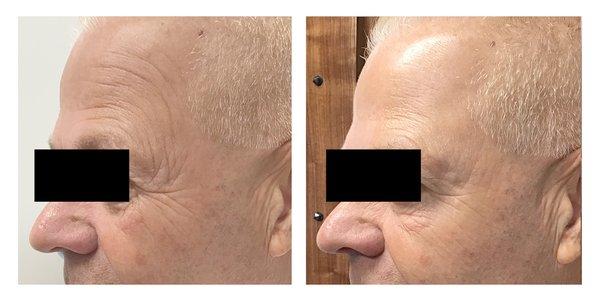 Forehead and Crow's Feet improved with Botox after a week