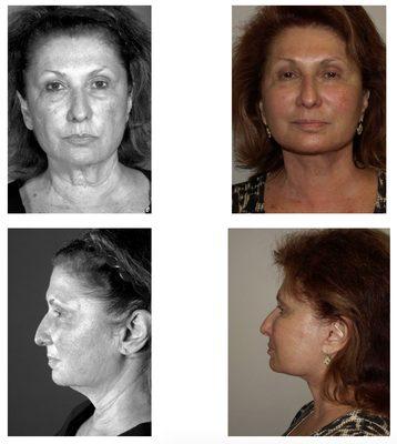 A 68 year old female with excess neck fat, sagging skin and diastasis of the platysma muscle. She did not want a full facelift.