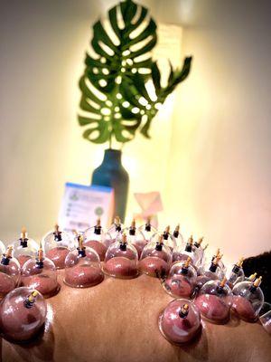 Cupping Therapy feels so good!