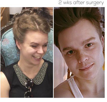 FTM:
 6 Weeks Post Op
 Genioplasty, jaw implants, rhinoplasty, Adam's Apple augmentation