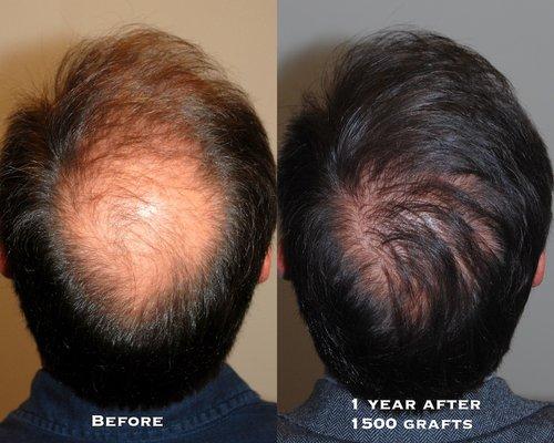 Hair Restoration Before and After