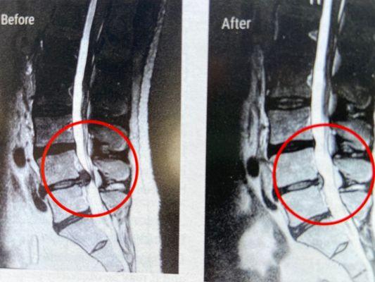 Un-bulge or un-herniate your disc.  Spinal Decompression for Frisco, The Colony, Plano, Little Elm, and Prosper, TX.