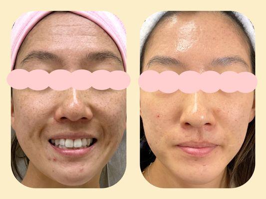 Laser acne scar treatment (8+ sessions) by Marie Jin, AG ACNP-BC