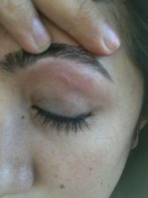 15 minutes after threading. Still red and a raised welt.