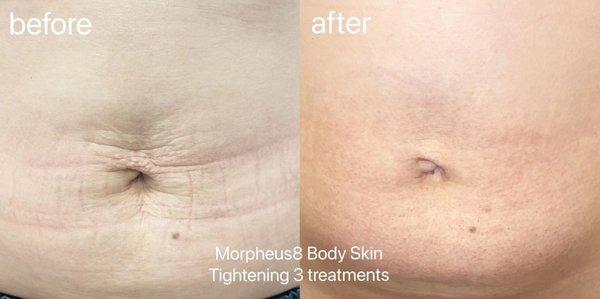 Loose Abdominal Skin treated by Morpheus8 Body - Results are amazing