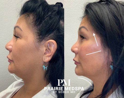 Non surgical facial contouring