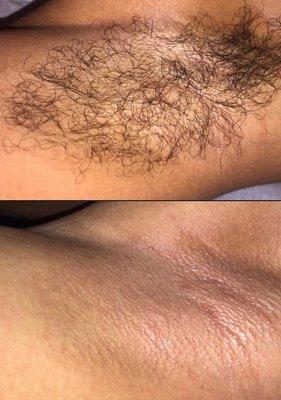 Underarms before & after