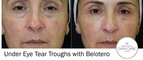 Belotero for Tear Troughs to treat hollowness and dark circles