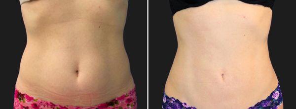 41-Year-Old Mother of One: Before and After Transformation with Lipo of Abdomen and Flanks in Tysons Corner, VA