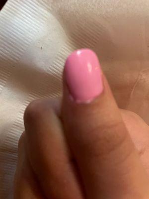 My older sister Carla had a horrible experience this is her ring finger!