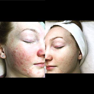 Pca chemical peel round one! Inflamed acne before and after also acne scars!