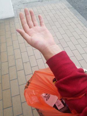 Bruised palm for carrying items and waiting in line for 30min