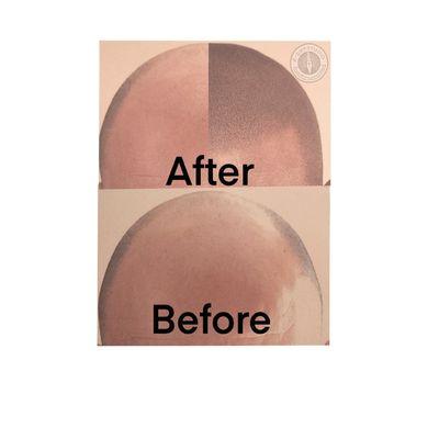 2dot alopecia  smp treatment