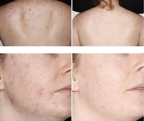 You can look and feel your best with Acne Clear! Fast acting light treatment with no drugs, no pain, and no downtime!