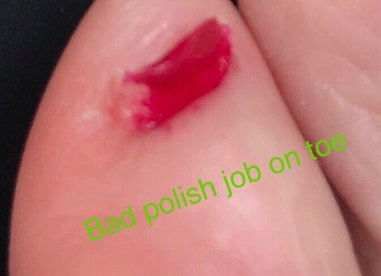 Cut nail too short. Into quick and sloppy polish job. Missing part of nail and painted skin