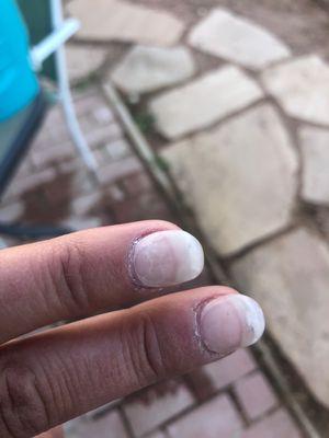 Both nails lifting on the sides