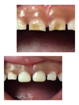 Pediactric White Crowns Before and After