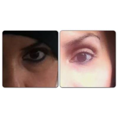 Before and after under eye restylane treatment.