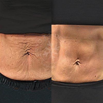 Cryo Body contouring  tightening & toning