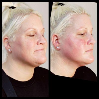 Non surgical 7D Ultra HIFU Lipo Plus cheek and Jaw line Tightening